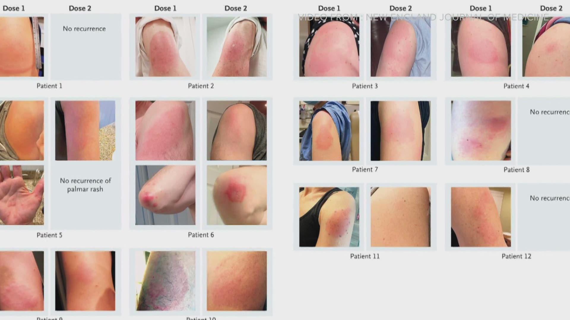 Doctors say while it is uncommon, it is nothing to be concerned about and a normal immune response.