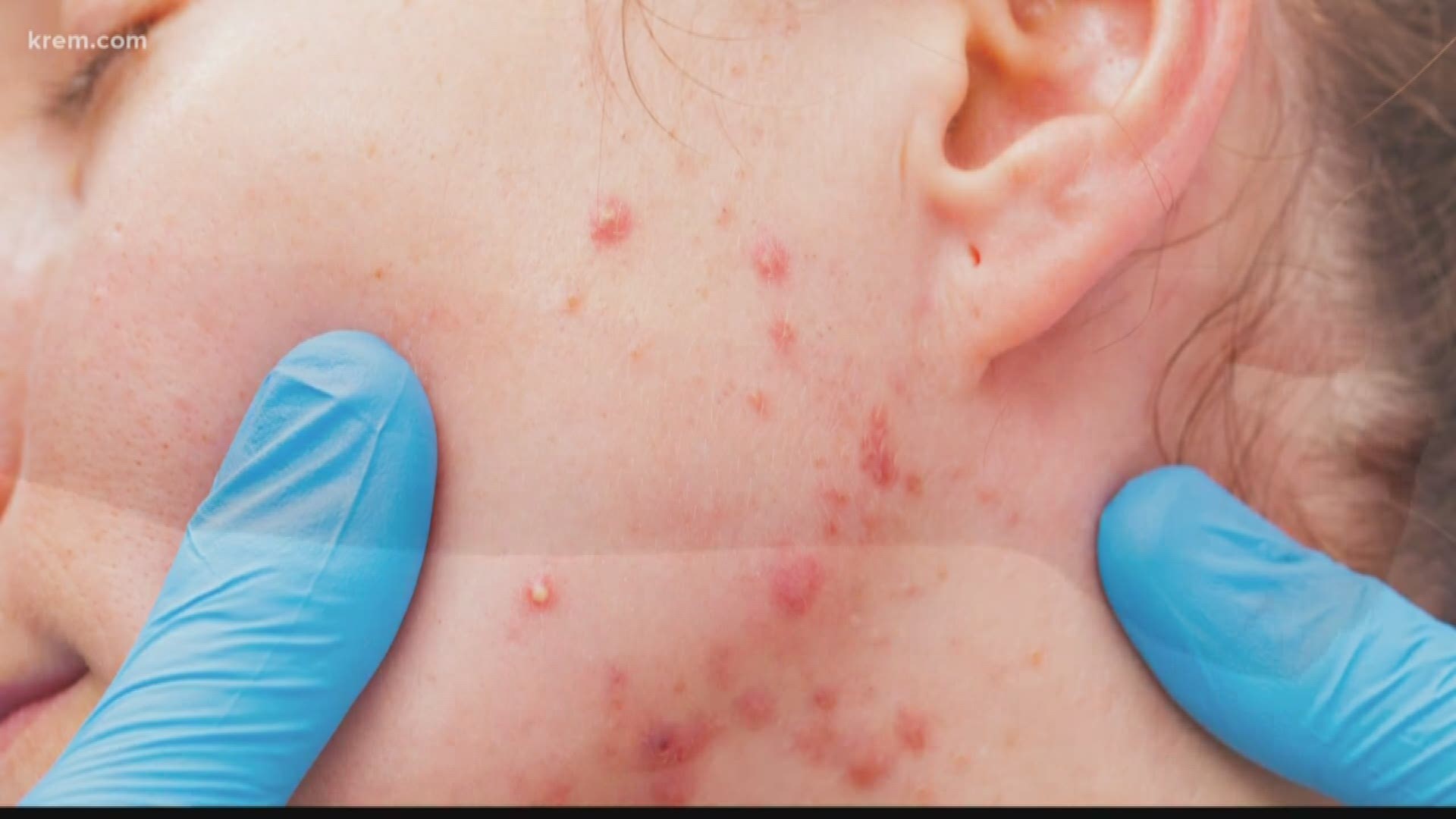 With the possibility of some measles cases coming to the eastern parts of Washington, doctors are advising parents on how keep their children safe
