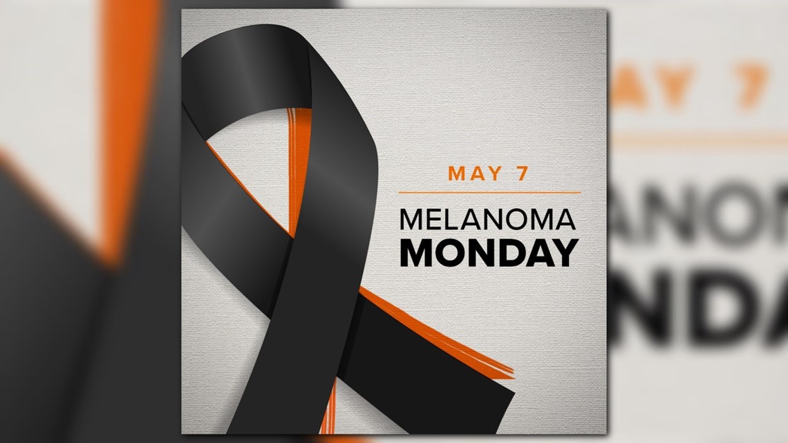 Monday is National Melanoma Day Here's what you should know