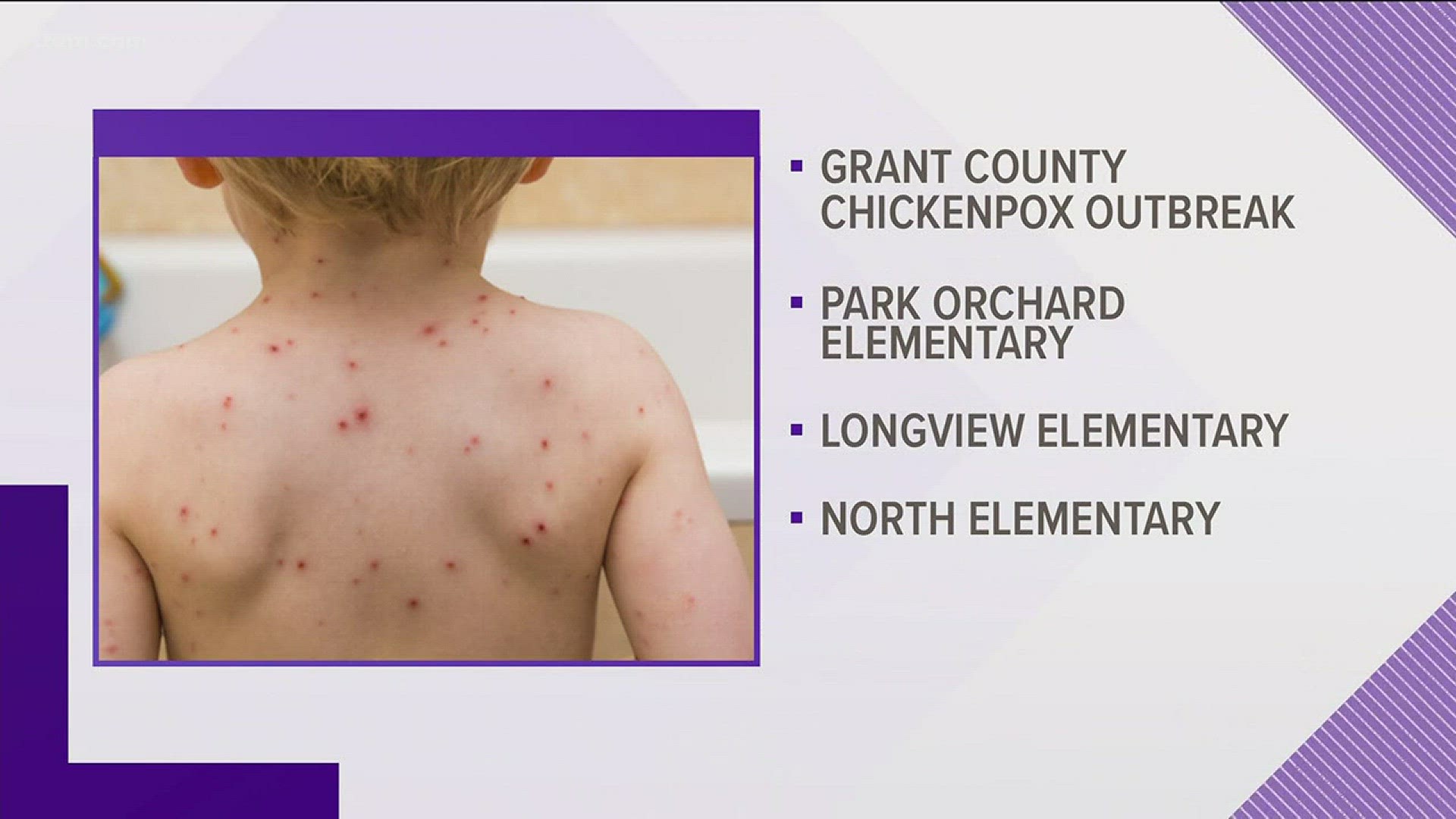 Three Moses Lake elementary schools dealing with chickenpox (9-14-18)
