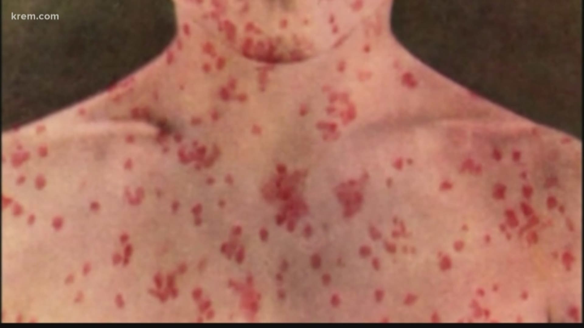 We wanted to know, why is Washington seeing a measles outbreak? And are other states seeing the same trend?