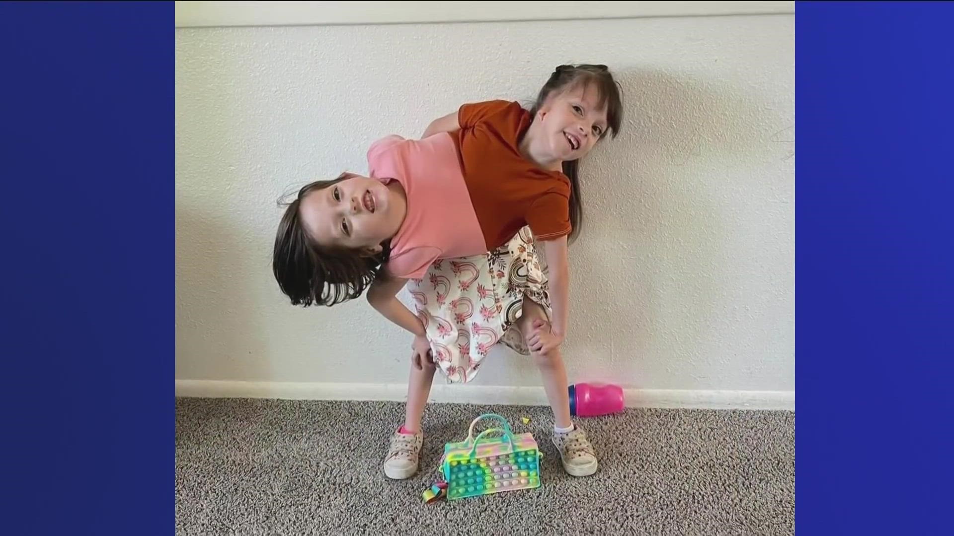 6-year-old girls Callie and Carter Torres are conjoined twins from eastern Idaho. Their mom shares their lives on social media to raise awareness.